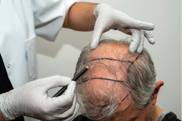 Hair Transplant treatment image 5